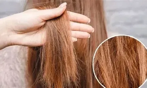 Rụng tóc nhiều vào mùa hè đừng chủ quan: 5 thói quen âm thầm gây hại
