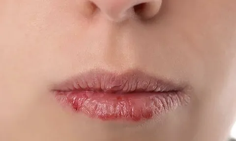 Muốn có một đôi môi hồng hào, căng mọng bạn hãy dừng lại ngay những thói quen này