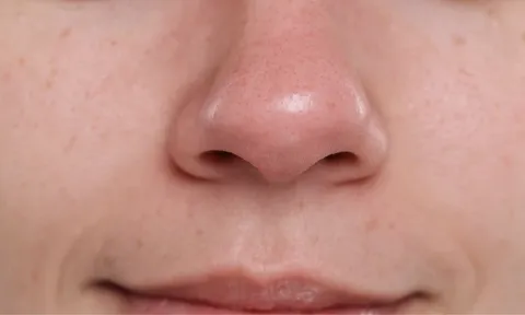 Mụn đầu đen tái đi tái lại dù chăm da kỹ? Nguyên nhân có thể nằm ở những thói quen hằng ngày của bạn
