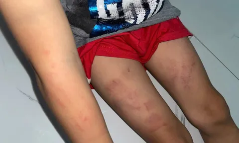 Công an điều tra vụ bé trai bị bầm tím sau khi gửi tại điểm trông trẻ ở Khánh Hòa