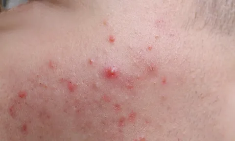 Sai lầm khiến trứng cá đỏ tái phát liên tục và 5 bước chăm sóc da dịu nhẹ