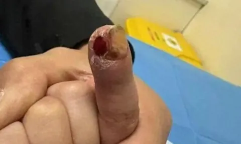 Cậu bé 7 tuổi suýt cắt bỏ ngón tay, bác sĩ nói nguyên nhân đến từ thói quen hàng ngày của trẻ, người mẹ hối hận