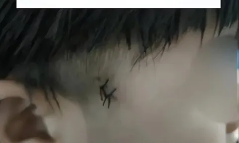 Mẹ giật mình phát hiện trên đầu con có đốm đen bất thường, đến bệnh viện khám bác sĩ thốt lên: “May quá, còn cứu kịp”