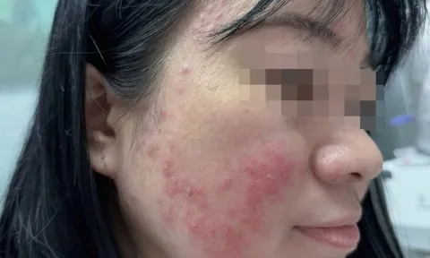 Tin vào một video viral trên Tiktok, nữ sinh tự "băm nát" gương mặt vì mải mê chữa mụn