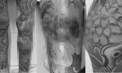 Thanh niên gặp biến chứng vì xăm kín 2 chân