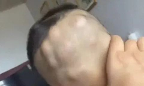 Con đi chơi về mẹ phát hiện đầu bé mọc nhiều khối u lớn như hạt óc chó, đến bệnh viện khám liền thất kinh