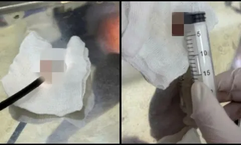 Món ăn "chua chua mặn mặn" vạn người mê này khiến cụ ông 72 tuổi nhập viện gấp