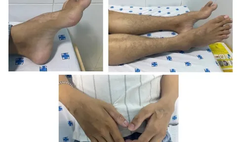 Mắc bệnh hiếm gặp từ biểu hiện tê yếu tay chân, không thể chủ quan với biểu hiện sức khỏe này