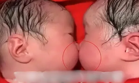 Cặp sinh đôi bám chặt lấy nhau khi mới chào đời, y tá không thể tách rời mà phải thốt lên: “Thật hiếm gặp”