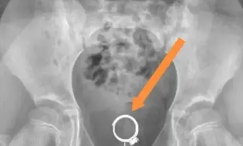 Con gái 6 tuổi kêu đau vùng dưới, bố mẹ sửng sốt khi nghe bác sĩ kết luận