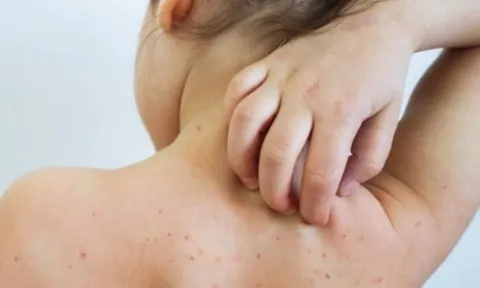 Hà Nội: Bé gái 7 tháng tuổi mắc rubella vì một sai lầm và sự chủ quan của bố mẹ