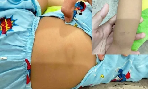 Nghi vấn bé gái gần 3 tuổi bị bạo hành tại điểm giữ trẻ ở Bình Thuận: Nghẹn lòng trước chẩn đoán của bác sĩ