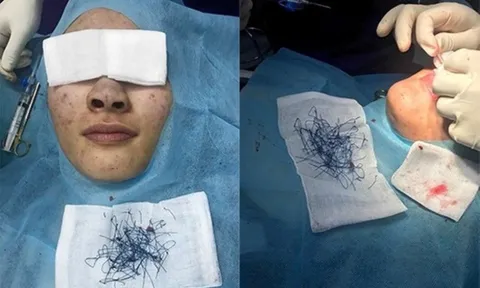 Sau ca phẫu thuật nâng mũi, cô gái bàng hoàng nhận ra thứ biến dạng trên mặt, chuyển màu xanh tím bất thường