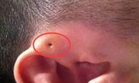 Mẹ phát hiện gần tai con xuất hiện một lỗ sâu khác thường liền tò mò bóp thử, không ngờ bác sĩ yêu cầu phẫu thuật ngay