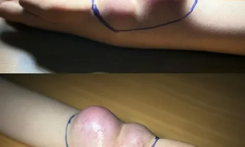 Cô gái trẻ suýt mất tay vì bệnh ung thư hiếm gặp chỉ vì chẩn đoán sai của bác sĩ