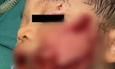 Xót xa bé 2 tuổi bị chó nhà nuôi tấn công phải nhập viện với nhiều vết thương phức tạp