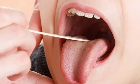 Sau ba tháng điều trị nốt sùi ở miệng nhưng không lành, người đàn ông sững sờ nhận chẩn đoán ung thư, cảnh giác ngay với dấu hiệu này