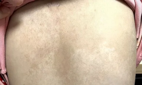 Con gái 5 tuổi có nhiều đốm nâu trên lưng, mẹ tưởng là tàn nhang nhưng đến bệnh viện bác sĩ đưa ra kết luận sốc