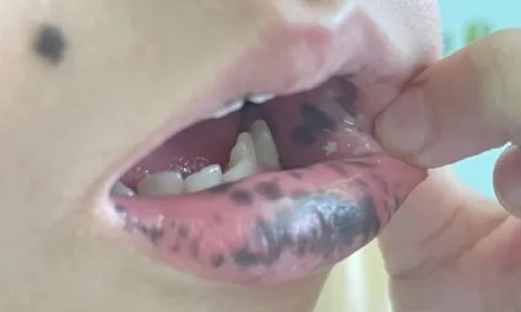 Mẹ phát hiện môi con gái 10 tuổi có nhiều đốm đen kỳ lạ, đến bệnh viện kiểm tra thì kinh hãi nghe bác sĩ nói