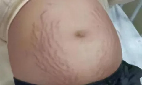 Mẹ nghi con gái lớp 3 mang thai vì bụng to bất thường, đi khám bác sĩ kết luận 5 chữ khiến mẹ gục ngã