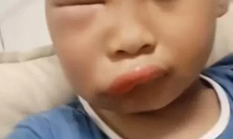 Gửi con về quê nghỉ hè với ông bà, ngày về đón mẹ tá hoả khi mặt đứa trẻ biến dạng