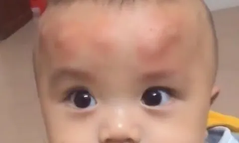 Con trai 2 tuổi ngủ dậy trên đầu liền xuất hiện nhiều khối u bất thường, người mẹ tá hoả khi biết nguyên nhân