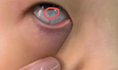 Con trai 10 tuổi mắt sưng húp, liên tục kêu ngứa, đưa đến bệnh viện khám mẹ thất kinh khi thấy vật thể lạ bên trong