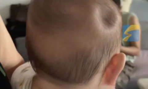 Bé trai 8 tháng tuổi gây xót xa khi đầu bị lõm xuống như một “chiếc hố”, chỉ vì sơ suất nhỏ của bố mẹ