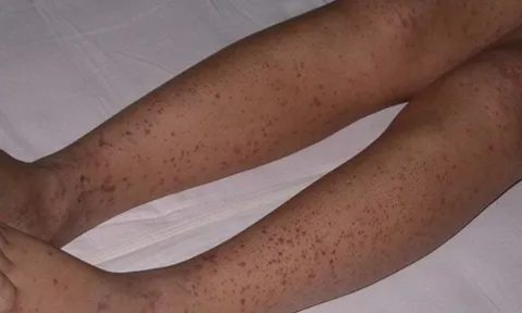 Tắm cho con gái, mẹ phát hiện chân đứa trẻ nổi loạt đốm đỏ, kết quả khám khiến gia đình đau khổ