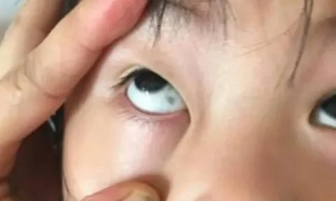 Phát hiện đốm đen trong tròng mắt con, gia đình hoang mang nhanh chóng cho bé nhập viện và cái kết không ngờ