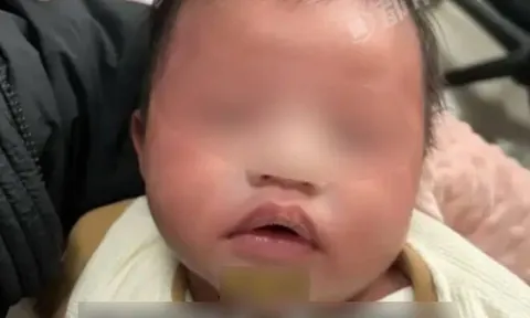 Bé sơ sinh 1 tháng tuổi nhập viện khẩn cấp vì bà nội dùng thứ nước này để pha sữa cho cháu