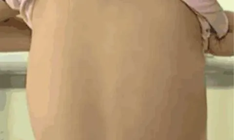 Tắm cho con gái, mẹ phát hiện lưng con có vấn đề, đến bệnh viện bác sĩ bắt phẫu thuật gấp