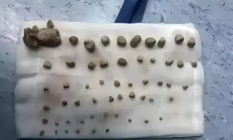 Bé gái 9 tuổi có 56 viên sỏi trong thận, BS chỉ ra nguyên nhân xuất phát từ thói quen sai lầm mà nhiều cha mẹ Việt hay mắc