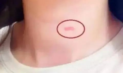 Con gái dậy thì có vết lạ trên cổ, mẹ ứng xử thông minh mọi phụ huynh nên học hỏi