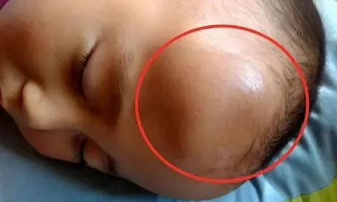 Bé 1 tuổi ngã, trên đầu hiện khối u lớn, cách xử lý của người mẹ bất ngờ nhận lời khen từ bác sĩ