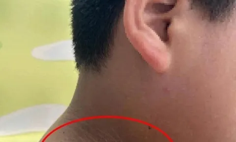 Mẹ phát hiện trên cổ, nách và đùi con trai dậy thì có những "vạch màu đen" kỳ lạ, bác sĩ cảnh báo nguy hiểm