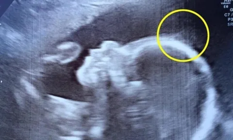 Đến viện siêu âm, mẹ bầu giật mình thấy điểm lạ trên đầu con, cái kết bé gái sinh ra đã nổi tiếng vì quá xinh