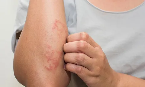 Ngứa râm ran ngoài da tưởng do thời tiết lạnh, không ngờ lại trở thành “cơn ác mộng” với cô gái trẻ ở Hà Nội