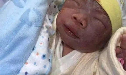Mẹ muốn khóc khi con sơ sinh chào đời tím tái như “củ khoai môn”, 3 tháng sau “lột xác” xinh như búp bê