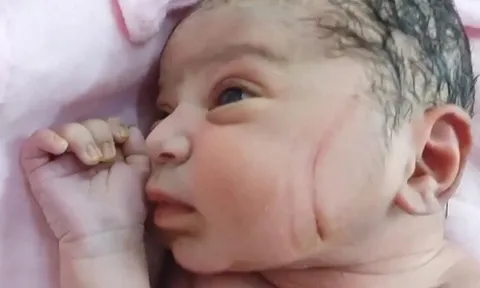 Vừa rời phòng đẻ phát hiện nhiều vết thương trên mặt con sơ sinh, gia đình nghi ngờ bác sĩ tắc trách, đòi kiện