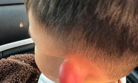 Con qua nhà hàng xóm chơi, về nhà lỗ tai bỗng sưng vù biến dạng, đưa vào viện bác sĩ khen mẹ giỏi