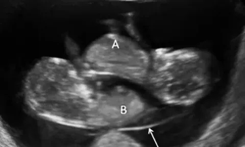 Bị thai nhi đá vào bụng đau điếng phải vào viện siêu âm, thông báo từ bác sĩ khiến bà bầu mừng như "trúng số độc đắc"