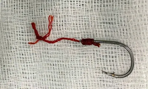 Móc câu cá có thể cắm sâu trong hậu môn, gây nguy hại sức khỏe trong trường hợp nào?