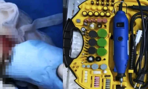 Gắn vòng ở vùng kín để tăng khoái cảm, 4 quý ông không tháo ra được, phải vào viện dùng máy khoan cắt bỏ