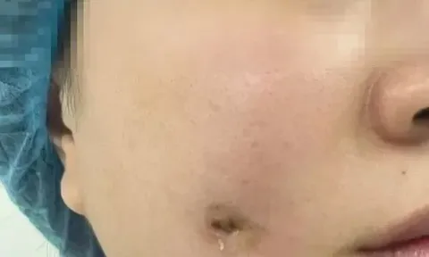 Cám cảnh: Ham má lúm đồng tiền nhân tạo, cô gái bị áp xe miệng