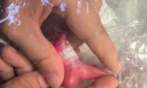 Bé gái sơ sinh chào đời chỉ nặng 660gr, bé tí như chai nước và cái kết sau 3 tháng khiến ai nấy ngã ngửa