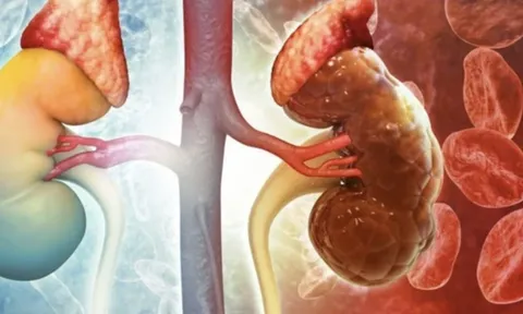 Cô gái trẻ hỏng thận vì thói quen ăn uống mà nhiều người đang "sở hữu" mỗi ngày