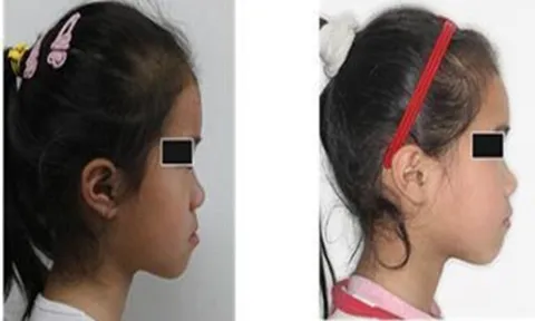 Con gái lúc nhỏ đẹp nhưng càng lớn càng móm, đến bệnh viện bác sĩ nói nguyên nhân khiến gia đình suy sụp