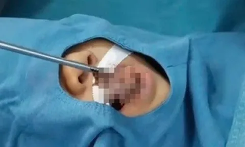 Hy Hữu: Bé trai 4 tuổi bị cá rô sống chui tọt vào cổ họng chỉ vì tò mò làm việc này, nhiều trẻ cũng như vậy