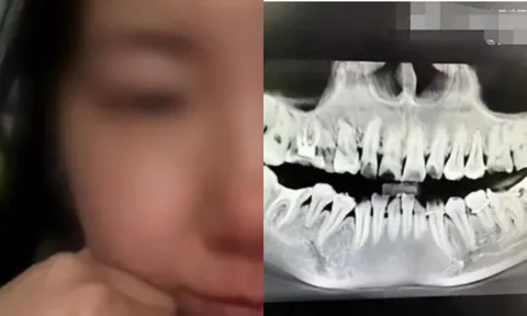 Người phụ nữ rơi từ tầng 11 bệnh viện sau khi bị nhổ nhầm răng, chịu đau đớn không thuốc tê